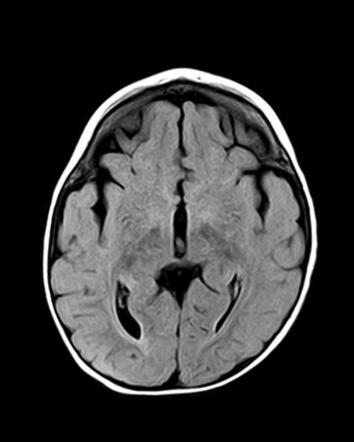 Pericallosal lipoma - curvilinear | Image | Radiopaedia.org