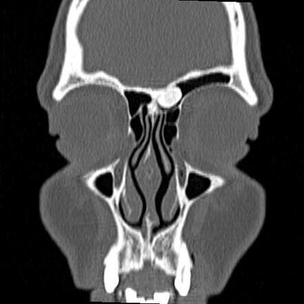 Frontal sinus osteoma | Radiology Case | Radiopaedia.org