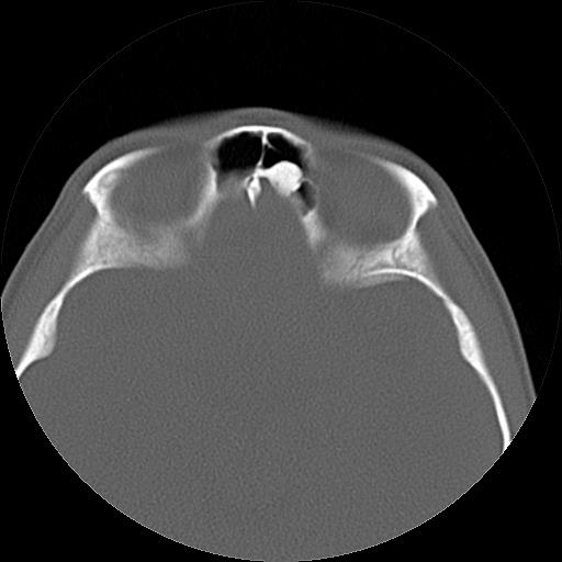 Frontal sinus osteoma | Image | Radiopaedia.org