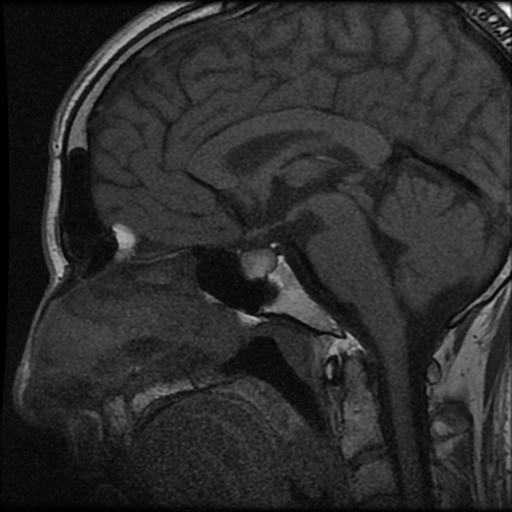 pituitary apoplexy icd 10