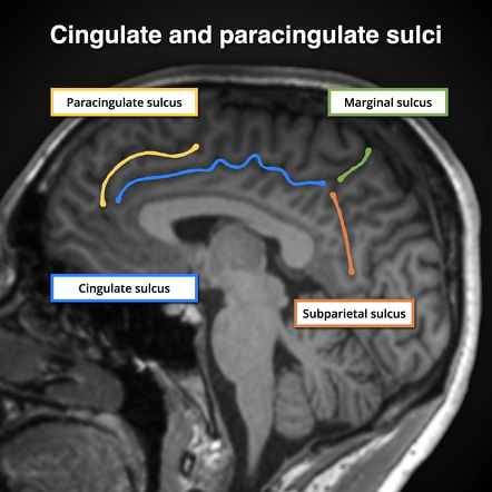 Cingulate Sulcus