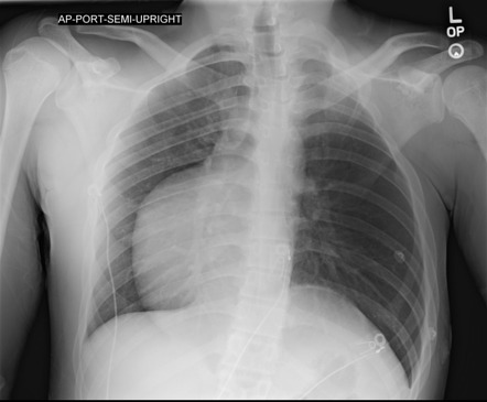 Dextrocardia and hypoplastic ribs | Radiology Case | Radiopaedia.org