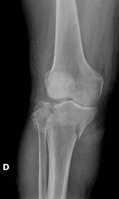 Tibial plateau fracture - Schatzker type VI | Image | Radiopaedia.org