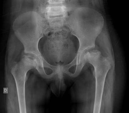 Legg-Calvé-Perthes disease - bilateral | Radiology Case | Radiopaedia.org