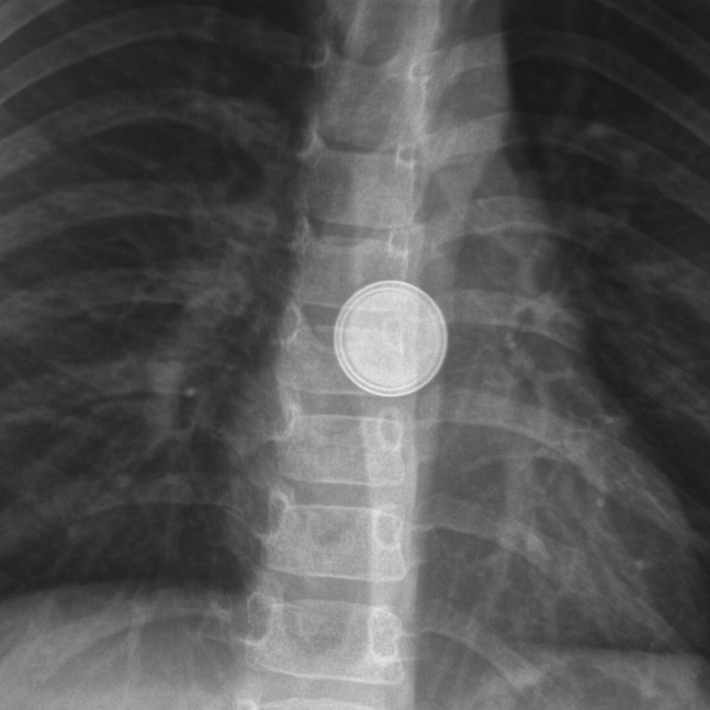 ingested-foreign-body-button-battery-image-radiopaedia