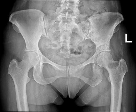 Pelvic metastases from breast cancer | Radiology Case | Radiopaedia.org