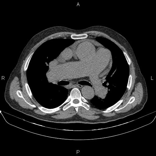 Cardiomegaly | Image | Radiopaedia.org