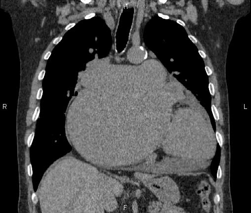 Cardiomegaly | Image | Radiopaedia.org