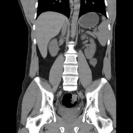 Ureterovesical junction calculus | Radiology Case | Radiopaedia.org