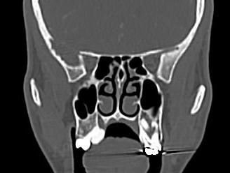 Peripheral osteoma of the hard palate | Image | Radiopaedia.org