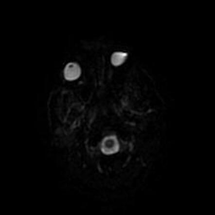 Oligodendroglioma - recurrence | Image | Radiopaedia.org