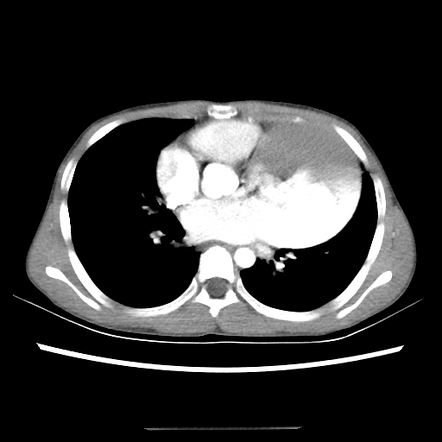 Left atrial appendage aneurysm | Image | Radiopaedia.org