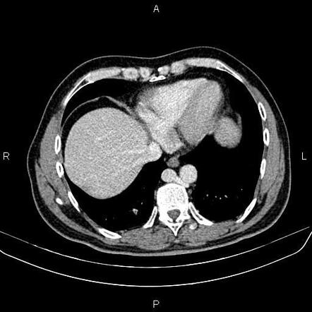 Azygos Vein Fetal Ultrasound