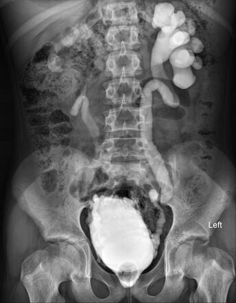 Neurogenic Bladder Radiology Case Radiopaedia Org