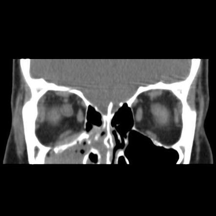 Orbital blow-out fracture and extraconal haematoma | Radiology Case ...