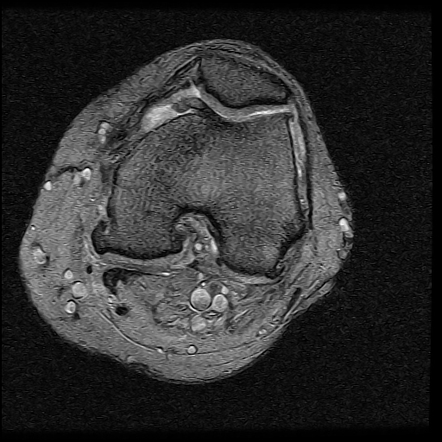 Medial collateral ligament bursitis associated with osteoarthritis ...