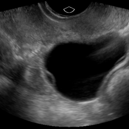 Ovarian follicular cyst | Image | Radiopaedia.org