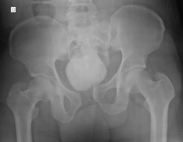 Open book pelvic injury, Radiology Reference Article