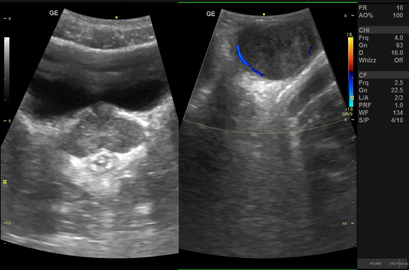 Seminoma 