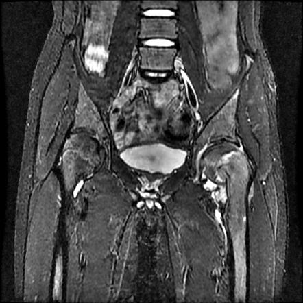 Salter-Harris type I fracture | Radiology Reference Article ...