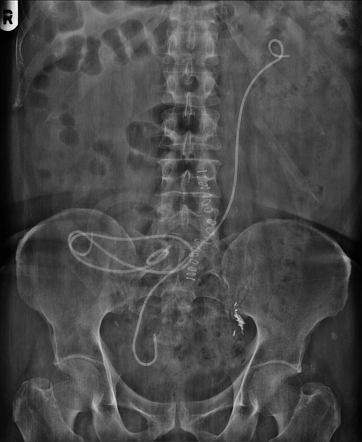 Ureteric stent migration | Radiology Case | Radiopaedia.org