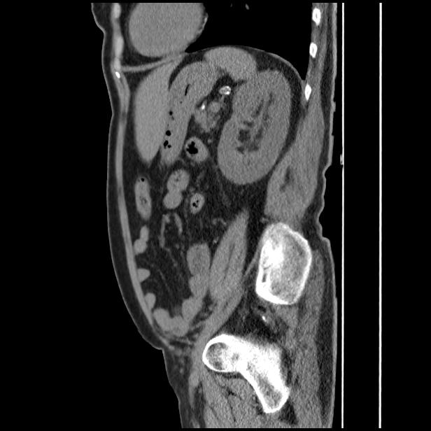 Gallbladder Adenocarcinoma | Image | Radiopaedia.org