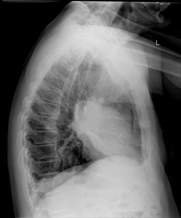 Lung cancer | Image | Radiopaedia.org