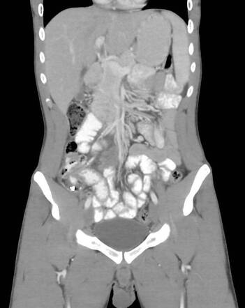 Calcifying fibrous tumour | Radiology Reference Article | Radiopaedia.org