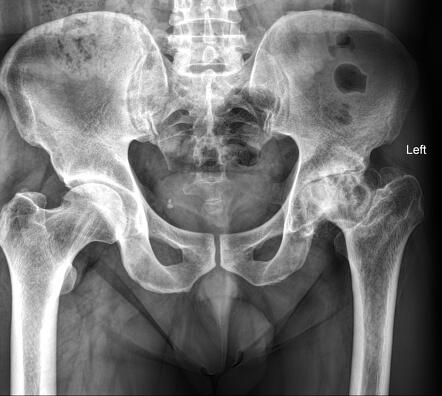 Long standing avascular necrosis of left femoral epiphysis | Radiology ...