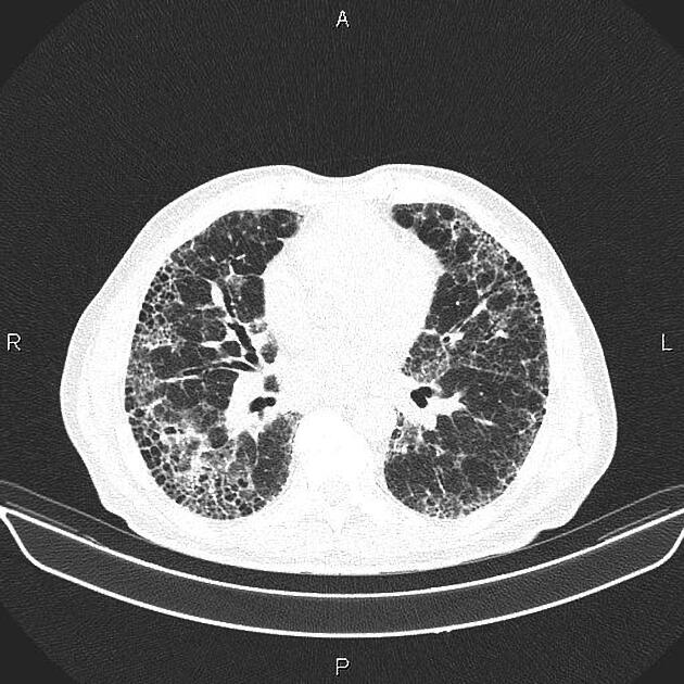 Pulmonary fibrosis | Radiology Reference Article | Radiopaedia.org