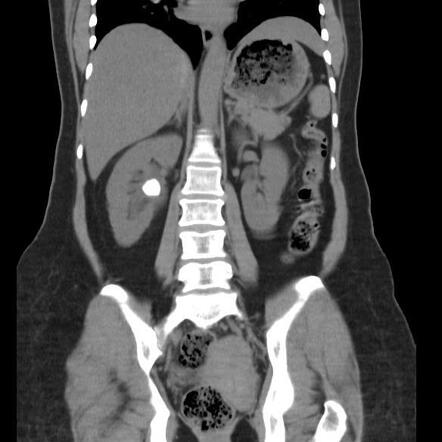 Renal pelvis calculus | Radiology Case | Radiopaedia.org