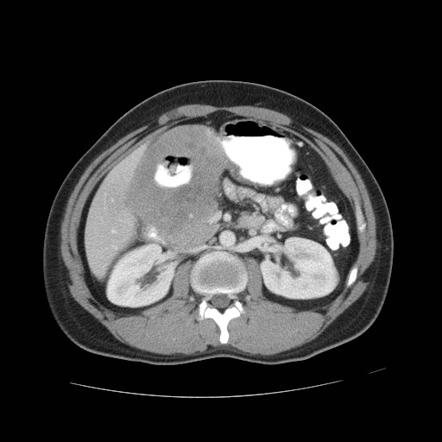 Gastric lymphoma | Radiology Reference Article | Radiopaedia.org