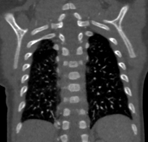 Patent ductus arteriosus clipping and coarctation of the aorta | Image ...