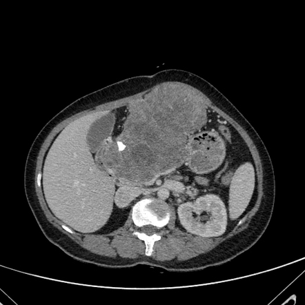 Serous cystadenoma of the pancreas | Radiology Case | Radiopaedia.org