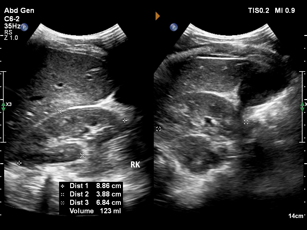 Normal renal Doppler ultrasound | Image | Radiopaedia.org