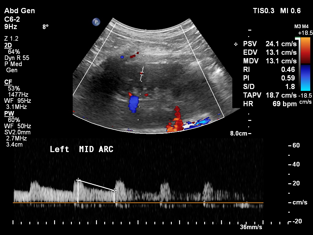 Normal renal Doppler ultrasound | Image | Radiopaedia.org