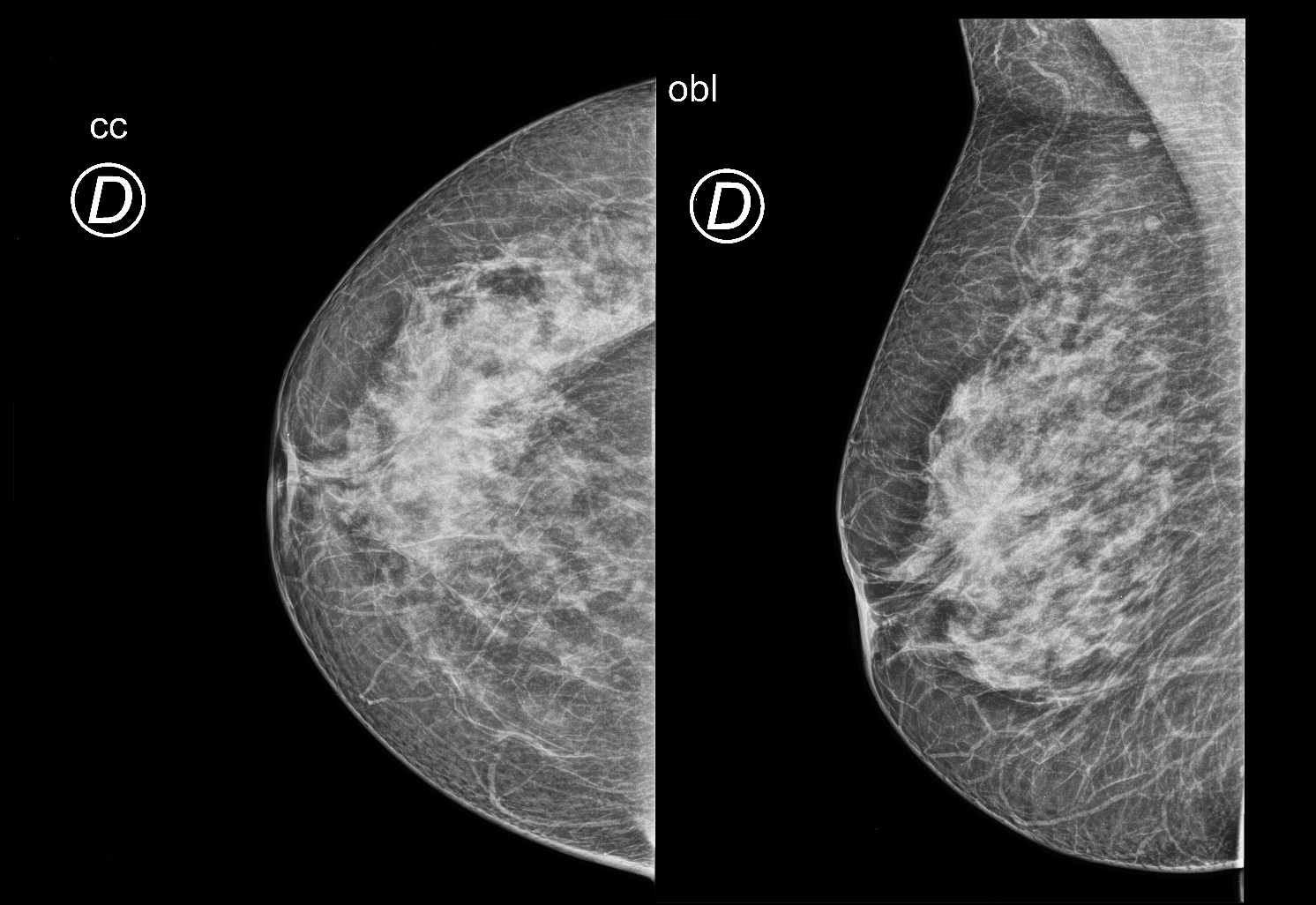 invasive-breast-carcinoma-of-no-special-type-image-radiopaedia