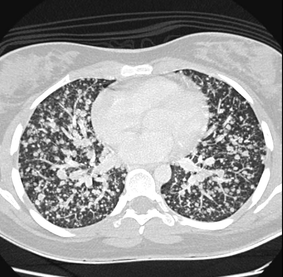 Miliary metastases from papillary thyroid cancer Image