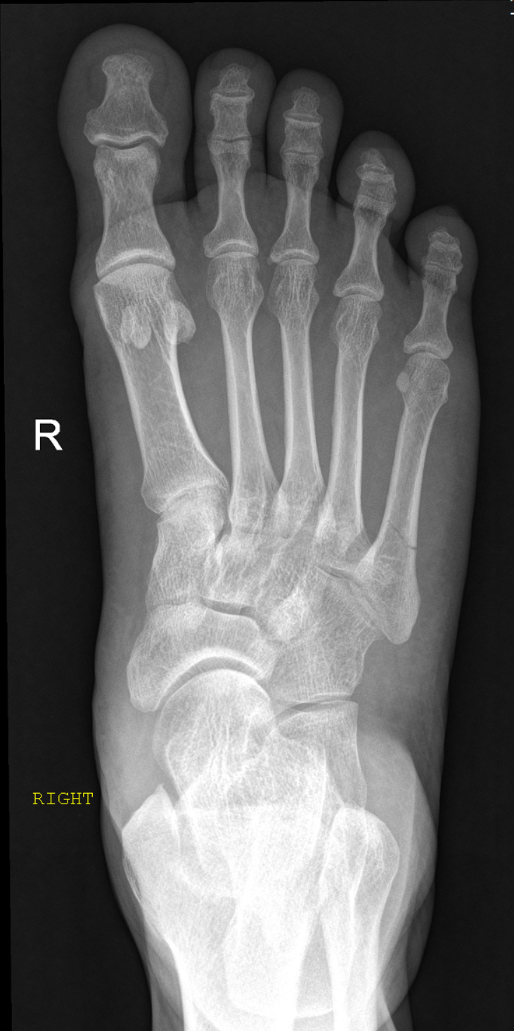 Jones Fracture Image