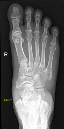 Jones fracture | Radiology Case | Radiopaedia.org