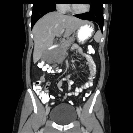 Gastric lymphoma | Image | Radiopaedia.org