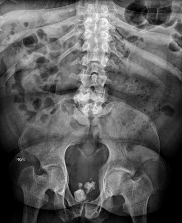 Caudal regression syndrome | Radiology Reference Article | Radiopaedia.org