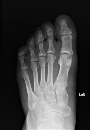 Phalangeal fractures | Radiology Case | Radiopaedia.org