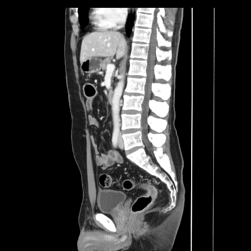 Ulcerative colitis | Image | Radiopaedia.org