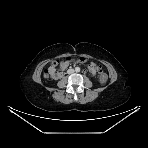 Non Occlusive Ischemic Colitis Image