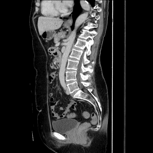 Non Occlusive Ischemic Colitis Image