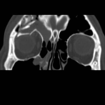 Orbital roof blow-in fracture | Radiology Case | Radiopaedia.org