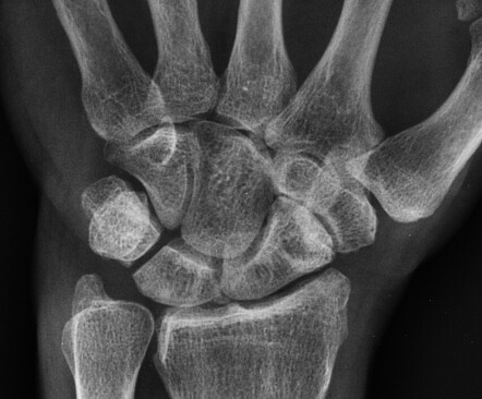 Phalanx fracture and scaphotrapeziotrapezoidal arthritis | Image ...