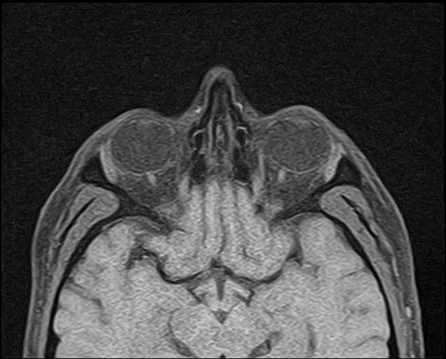 Idiopathic intracranial hypertension (IIH) | Image | Radiopaedia.org