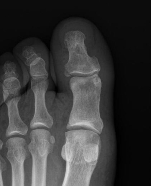 Phalanx fracture Radiology Reference Article Radiopaedia